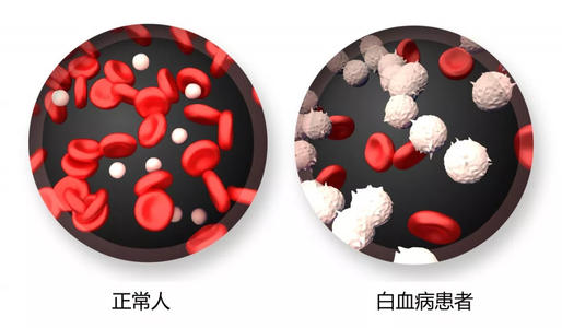 什么人容易得白血病？白血病的4大病因易感人群及预防注意事项